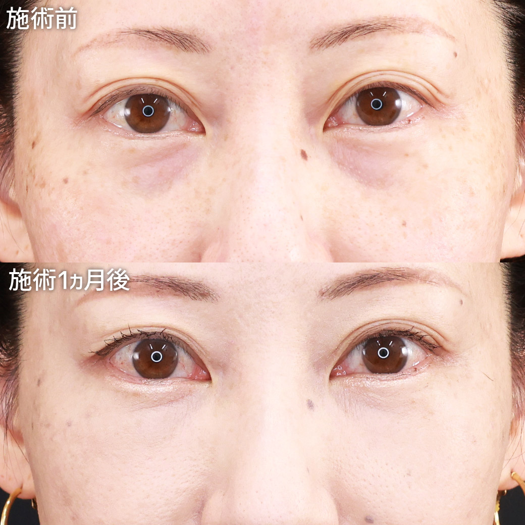 【クマ取り脂肪注入】目の下の膨らみを無くし、疲れ見えを解消！