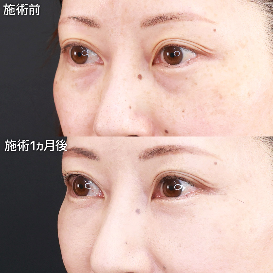 下眼瞼脱脂術（目の下のたるみ取り・目の下の脂肪ふくらみ取り）/顔の脂肪注入(コンデンスリッチフェイス)の症例写真 施術前後 