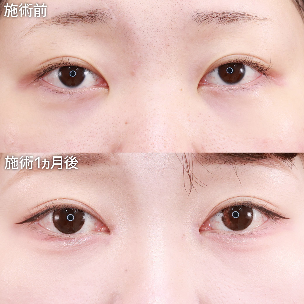 【目頭切開】蒙古襞の張りを解除し、ナチュラルに離れ目を改善！