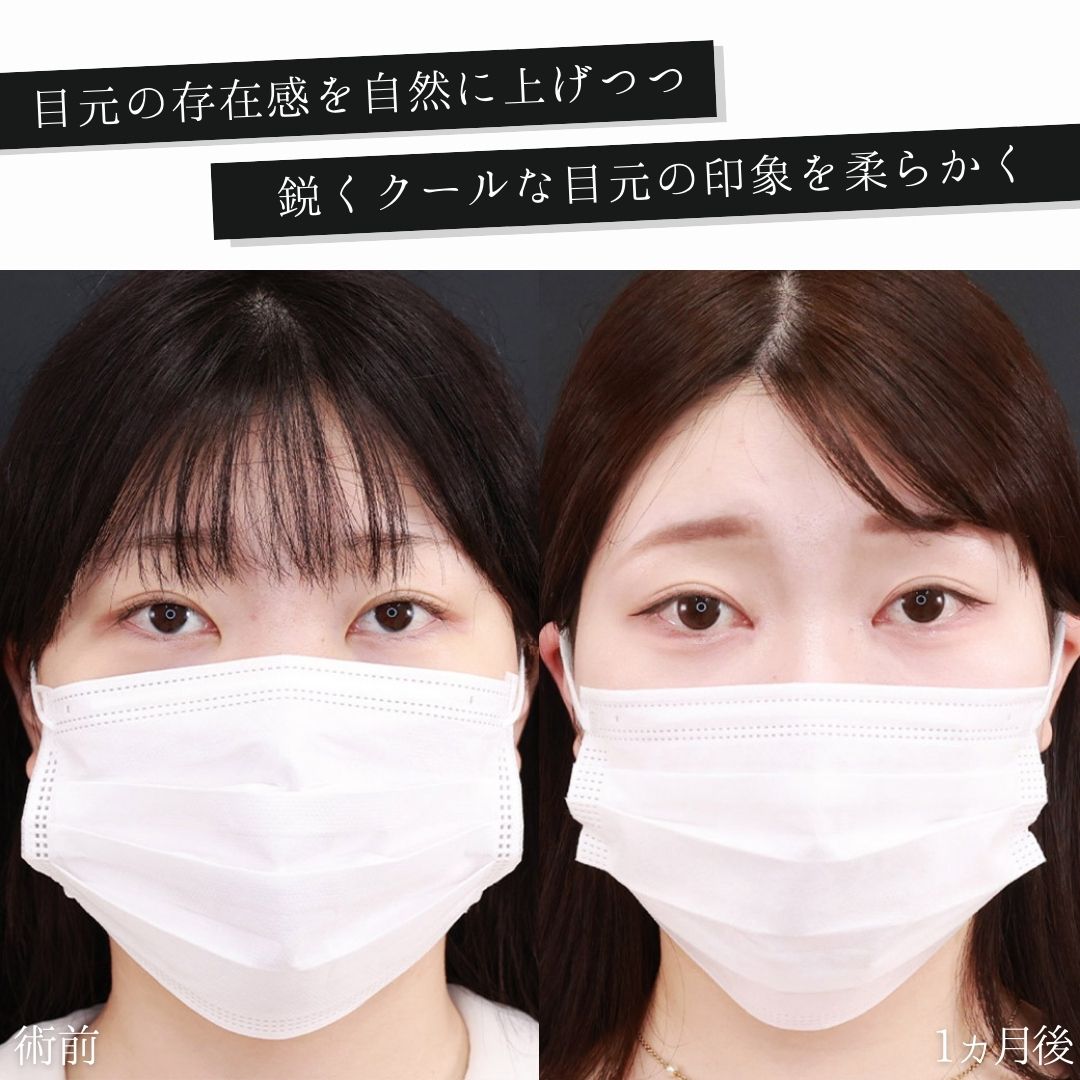 目頭切開術の症例写真 施術前後 