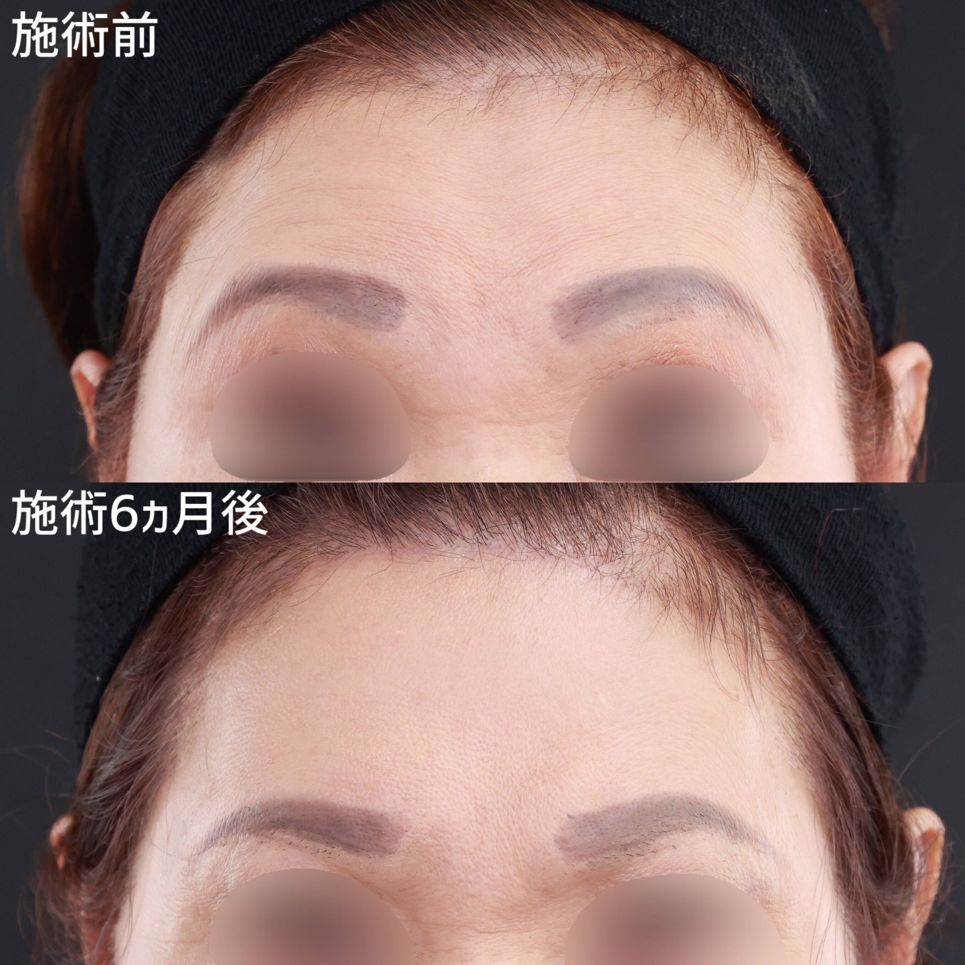 【前額リフト】シワを根本的に改善！若々しく明るい表情に！