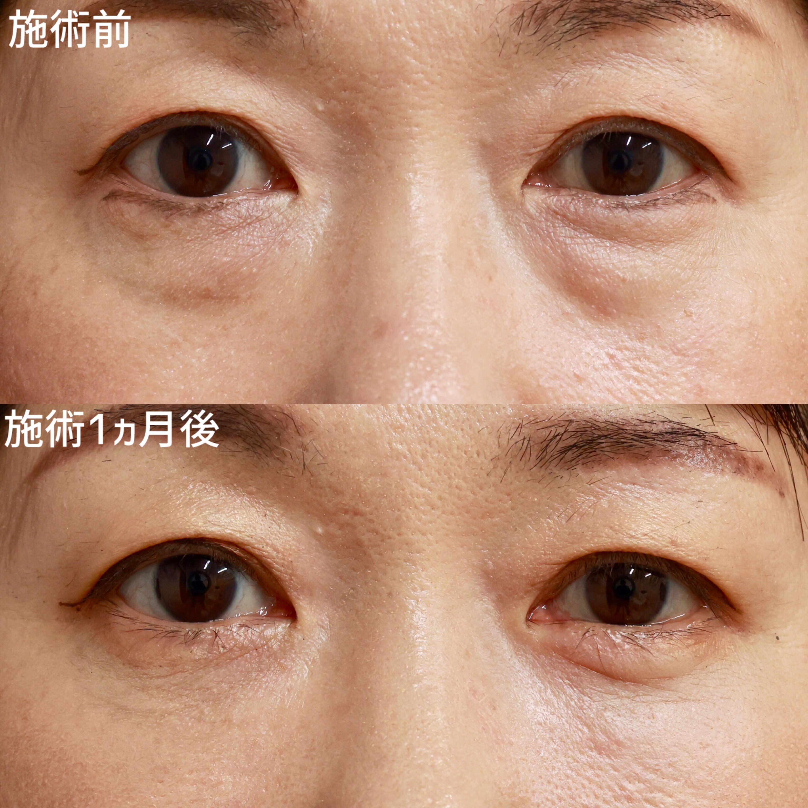 【裏ハムラ法】目の下の凹凸を改善し明るい目元に