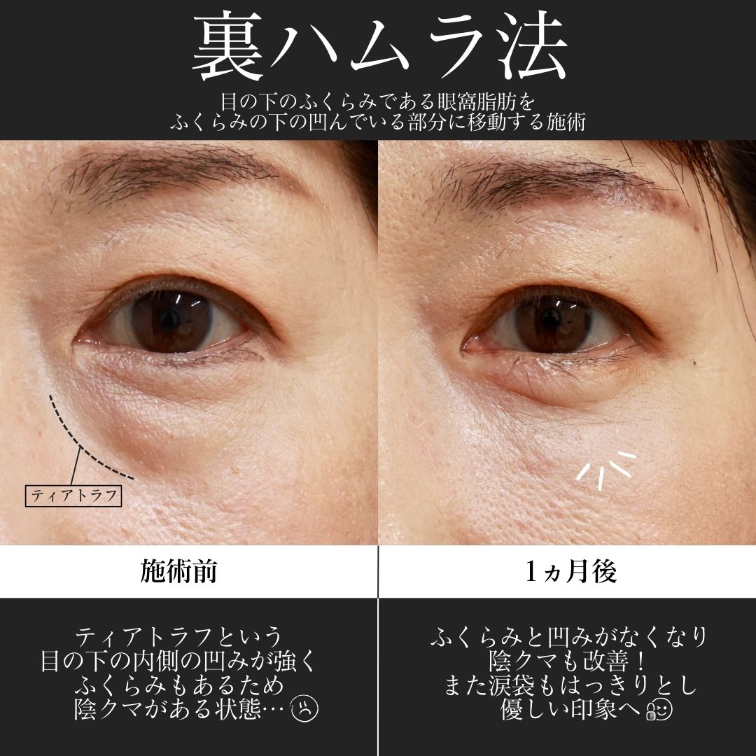 下眼瞼脱脂術（目の下のたるみ取り・目の下の脂肪ふくらみ取り）の症例写真 施術前後 