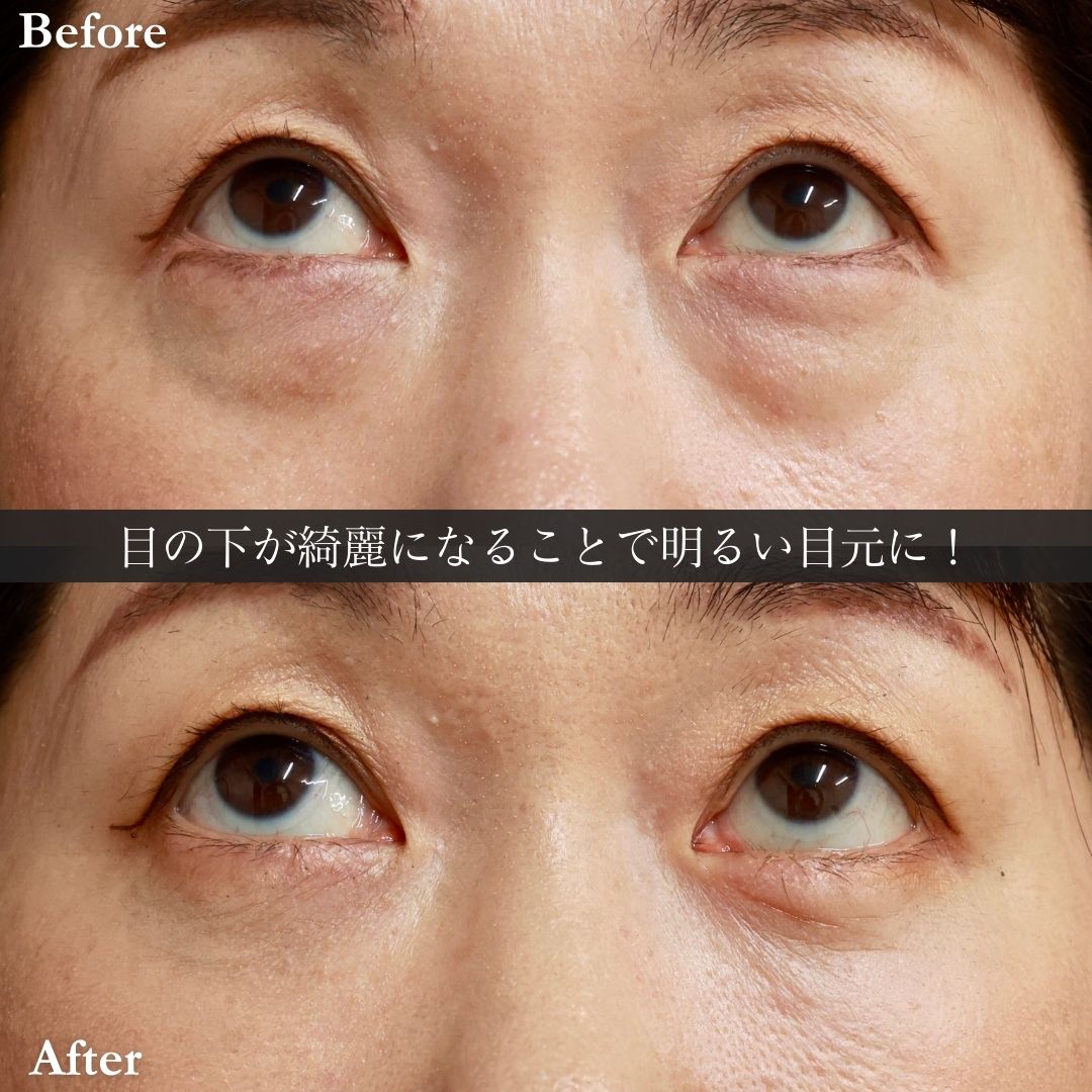 下眼瞼脱脂術（目の下のたるみ取り・目の下の脂肪ふくらみ取り）の症例写真 施術前後 