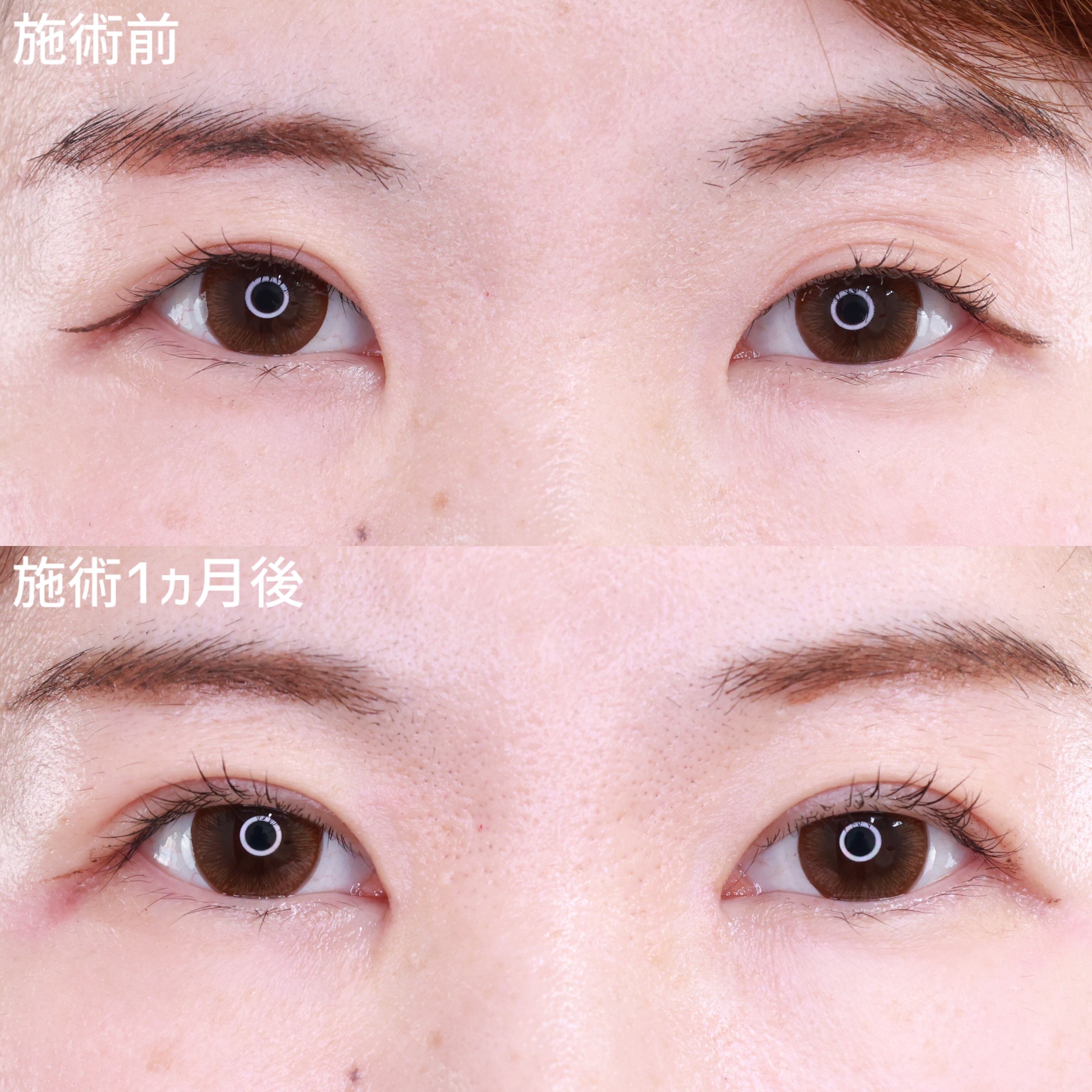 【二重切開】たるみを改善しみんなに褒められる目元に