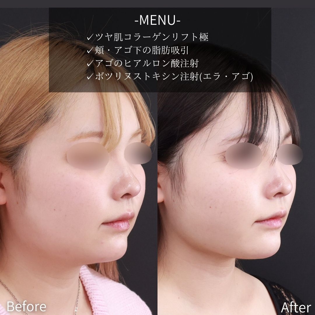 小顔整形｜パーフェクトフェイスライン/TAC式 ツヤ肌コラーゲンリフト®/顎下の脂肪吸引の症例写真 施術前後 