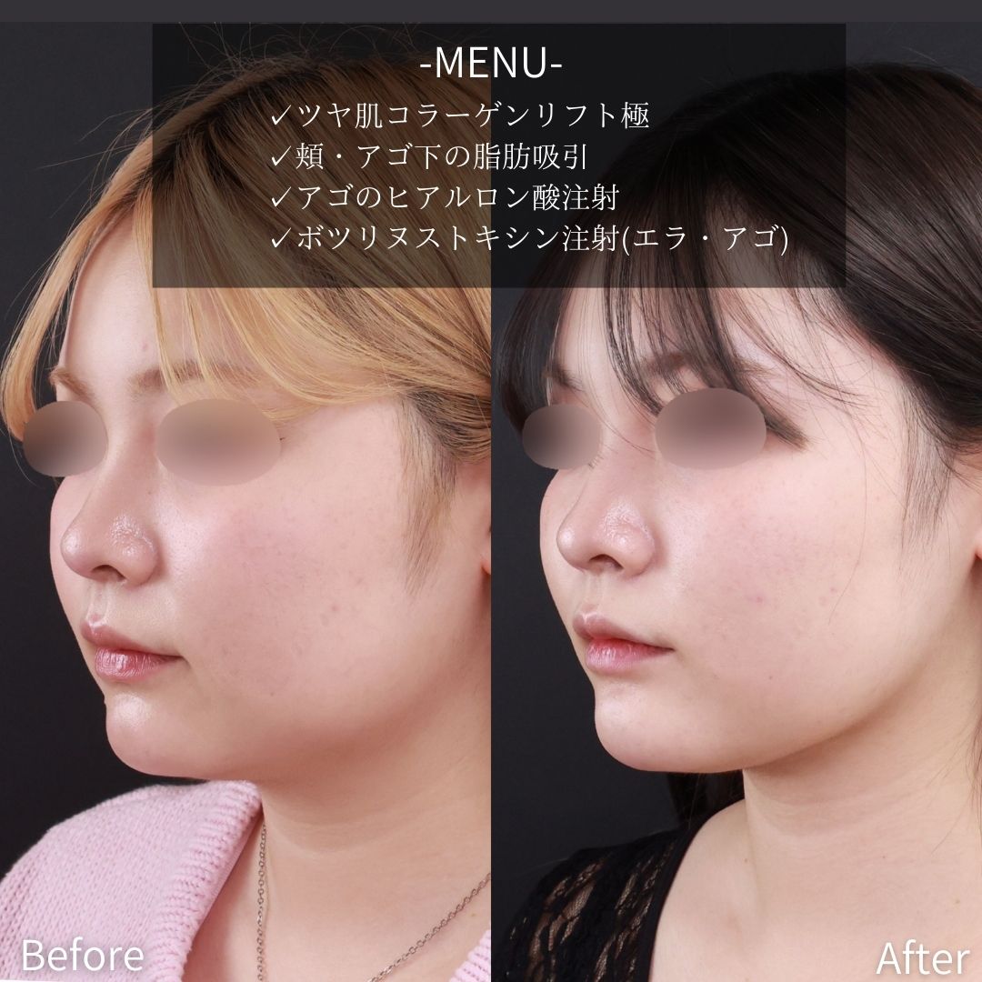 小顔整形｜パーフェクトフェイスライン/TAC式 ツヤ肌コラーゲンリフト®/顎下の脂肪吸引の症例写真 施術前後 