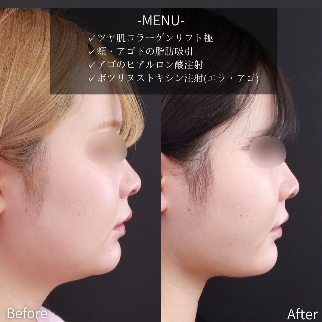 小顔整形｜パーフェクトフェイスライン/TAC式 ツヤ肌コラーゲンリフト®/顎下の脂肪吸引の症例写真 施術前後 