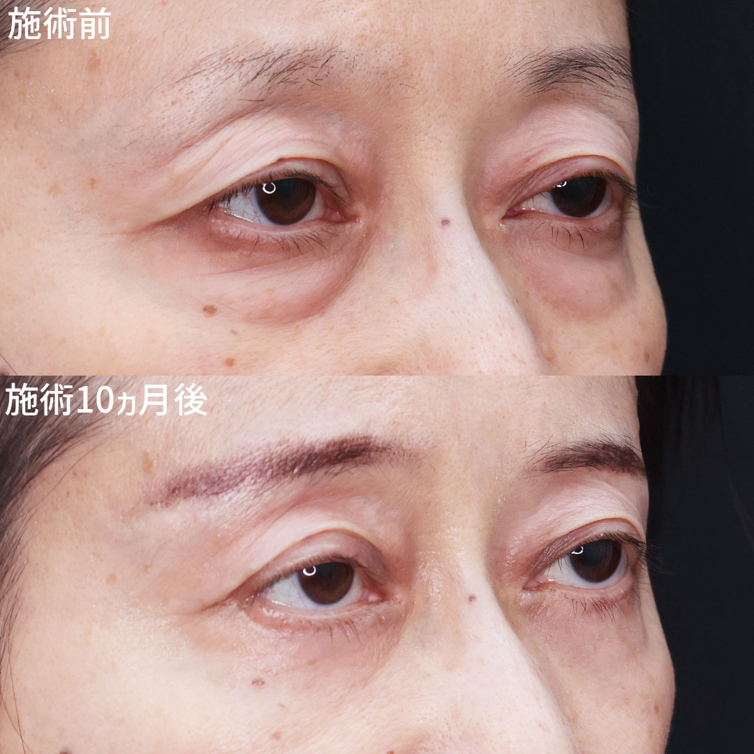 目の周りのたるみを改善！若々しいお目元に◎