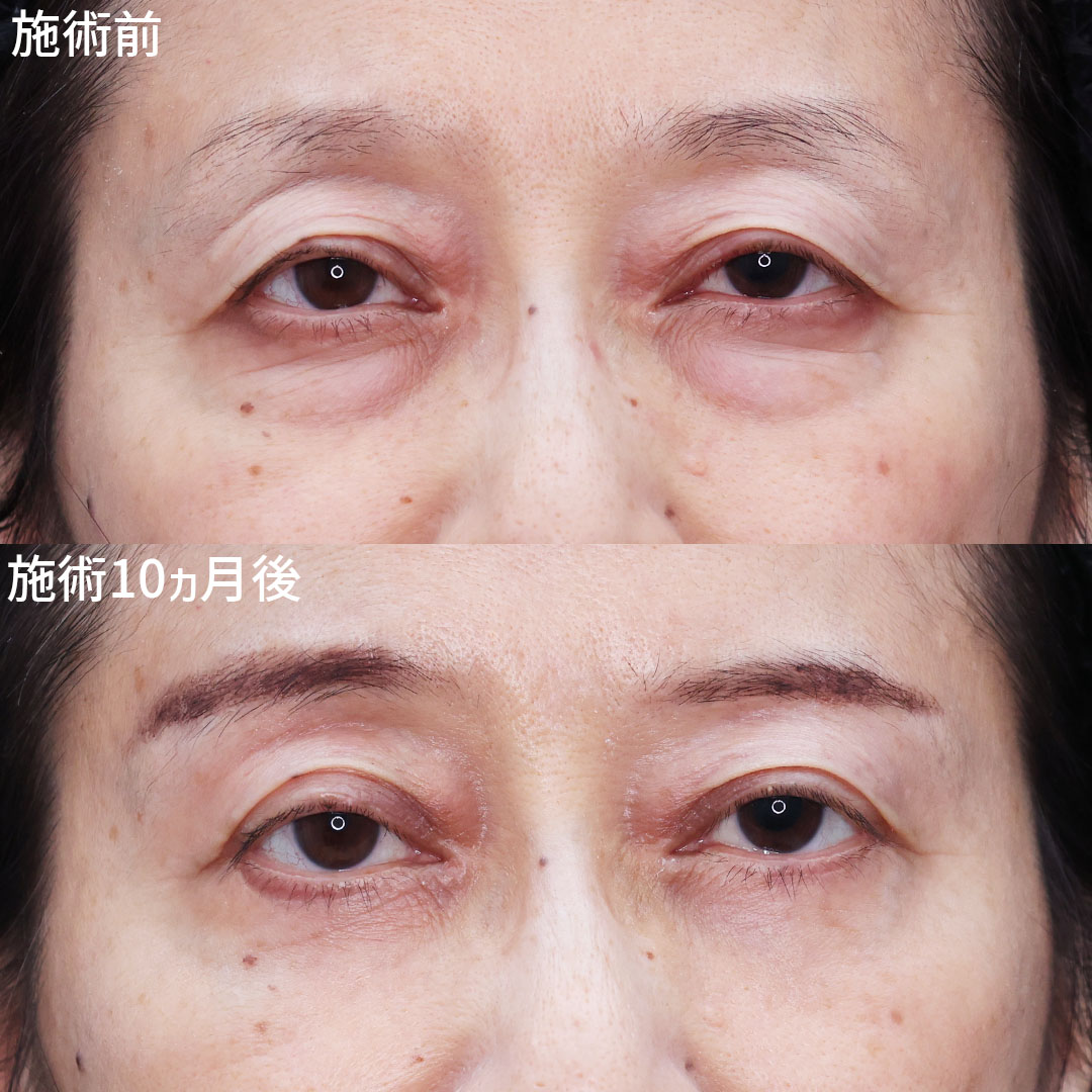 眉毛下切開術/下眼瞼切開術（クマ・たるみとり）/下眼瞼脱脂術（目の下のたるみ取り・目の下の脂肪ふくらみ取り）の症例写真 施術前後 