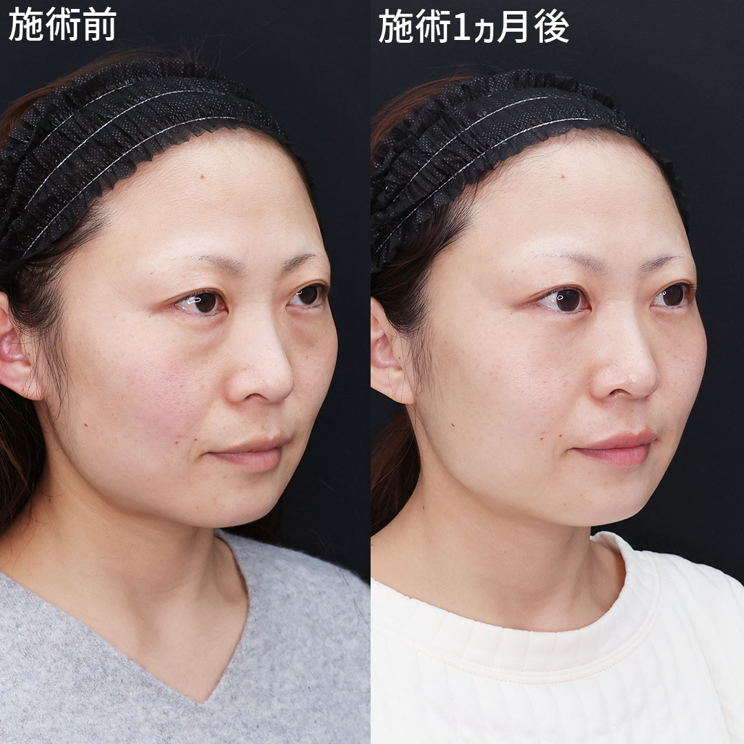 変わったのは目元だけ【クマ取り】で印象改善！