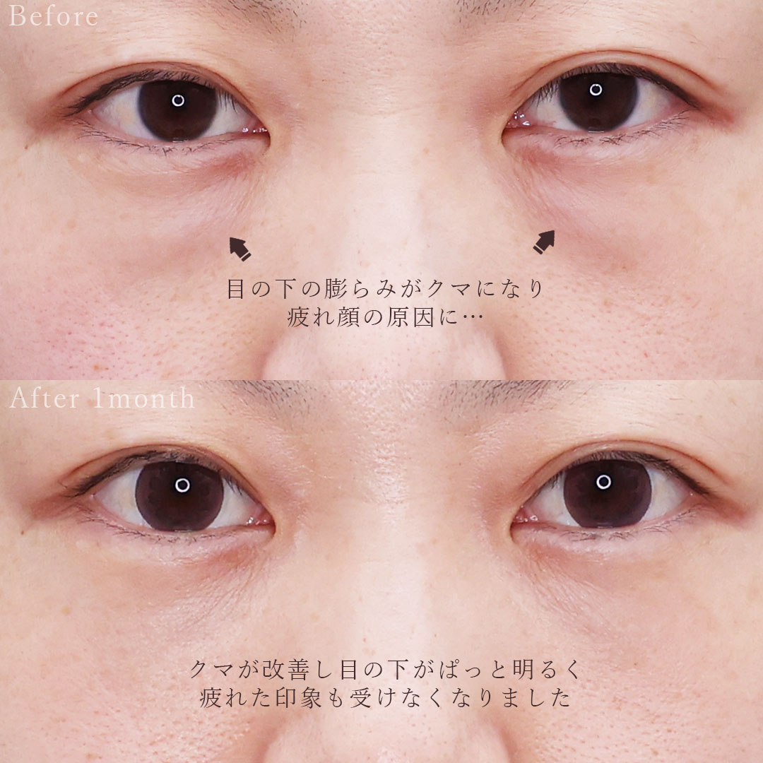 下眼瞼脱脂術（目の下のたるみ取り・目の下の脂肪ふくらみ取り）の症例写真 施術前後 