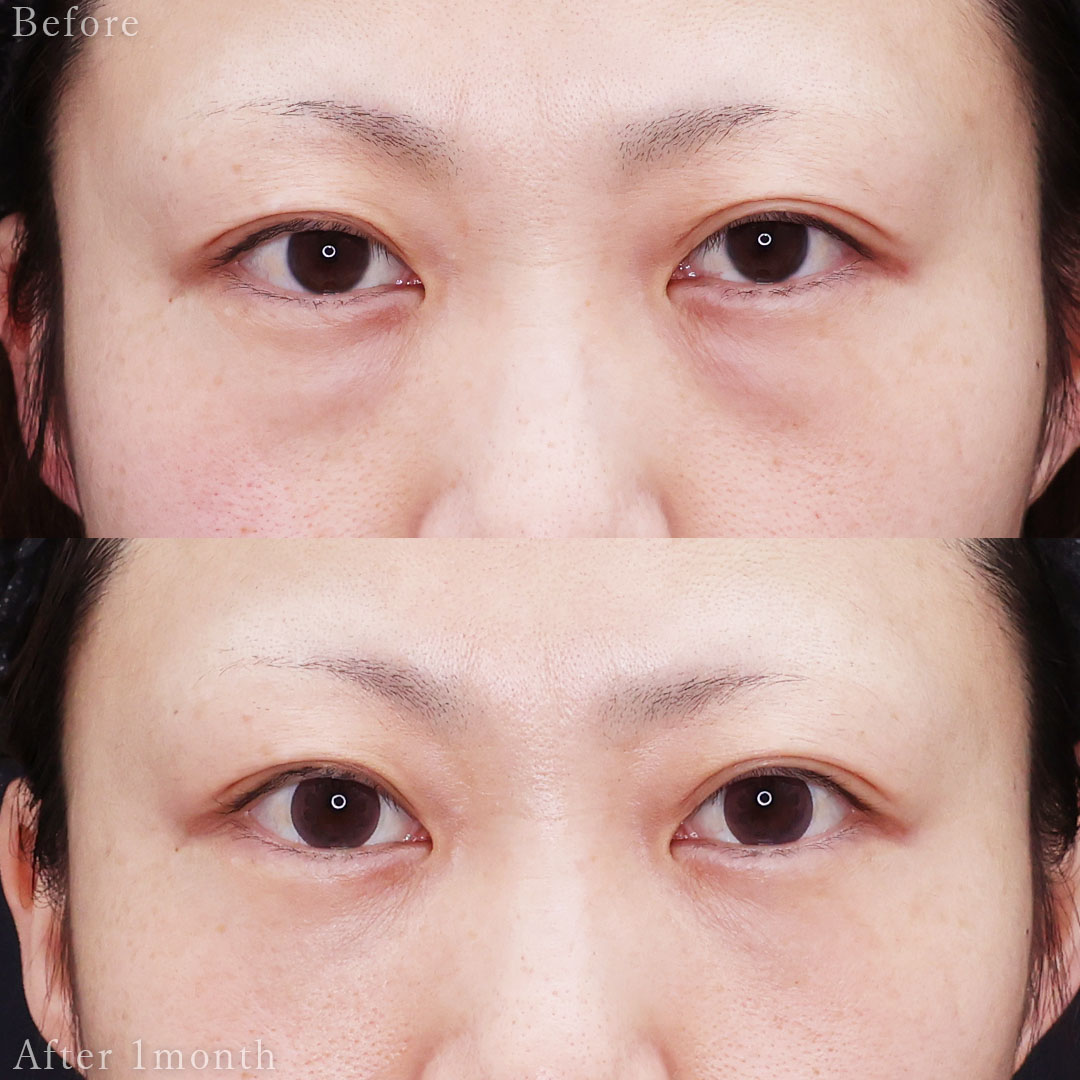 下眼瞼脱脂術（目の下のたるみ取り・目の下の脂肪ふくらみ取り）の症例写真 施術前後 