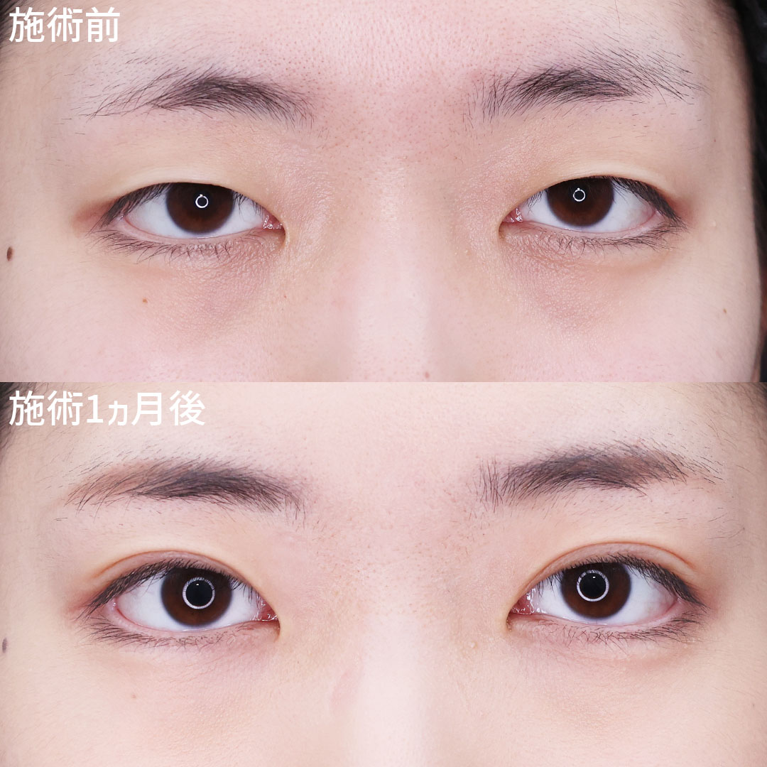 【埋没法】で更に大きく、魅力的な目に