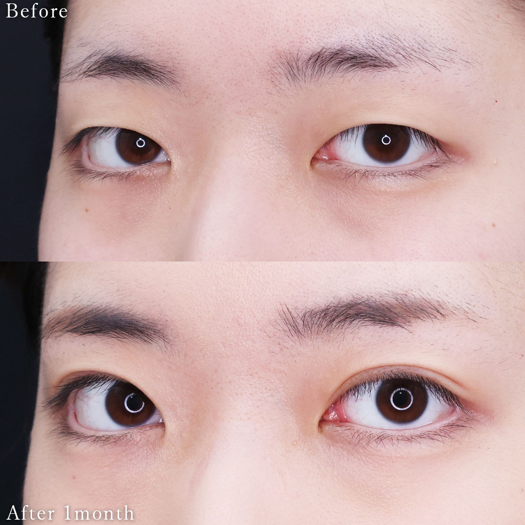 二重埋没法の症例写真 施術前後 