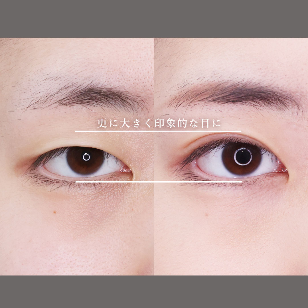 二重埋没法の症例写真 施術前後 