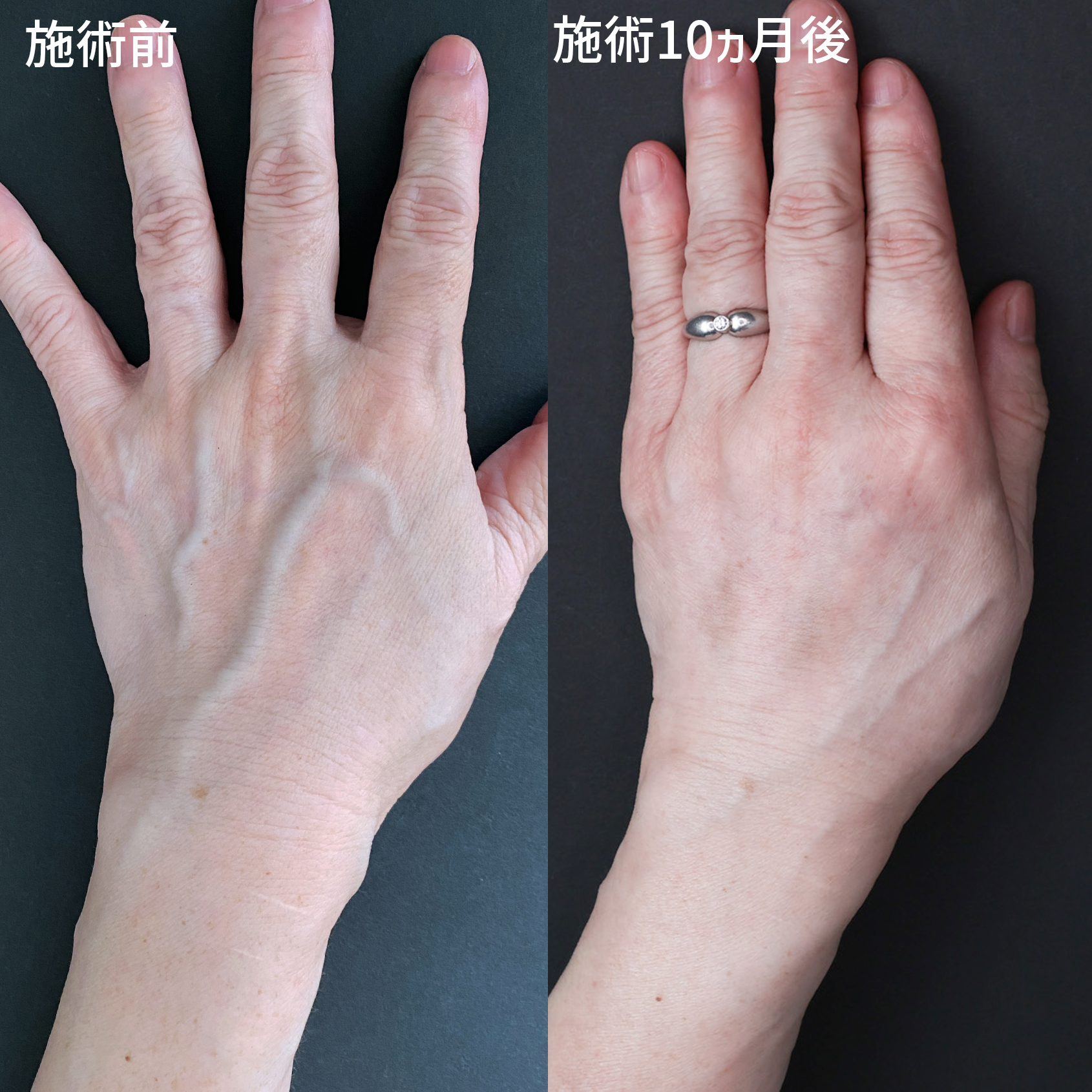 ハンドベイン（手のアンチエイジング・血管治療）の症例写真 施術前後 