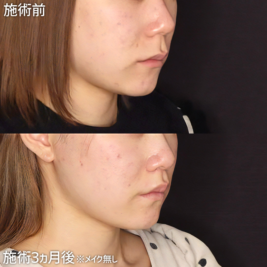 人中短縮術(リップリフト)・外側人中短縮術の症例写真 施術前後 