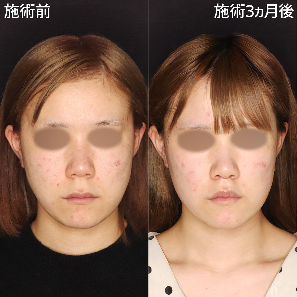 【人中短縮術＆外側人中短縮術】唇全体を持ち上げ、長い鼻下を短く