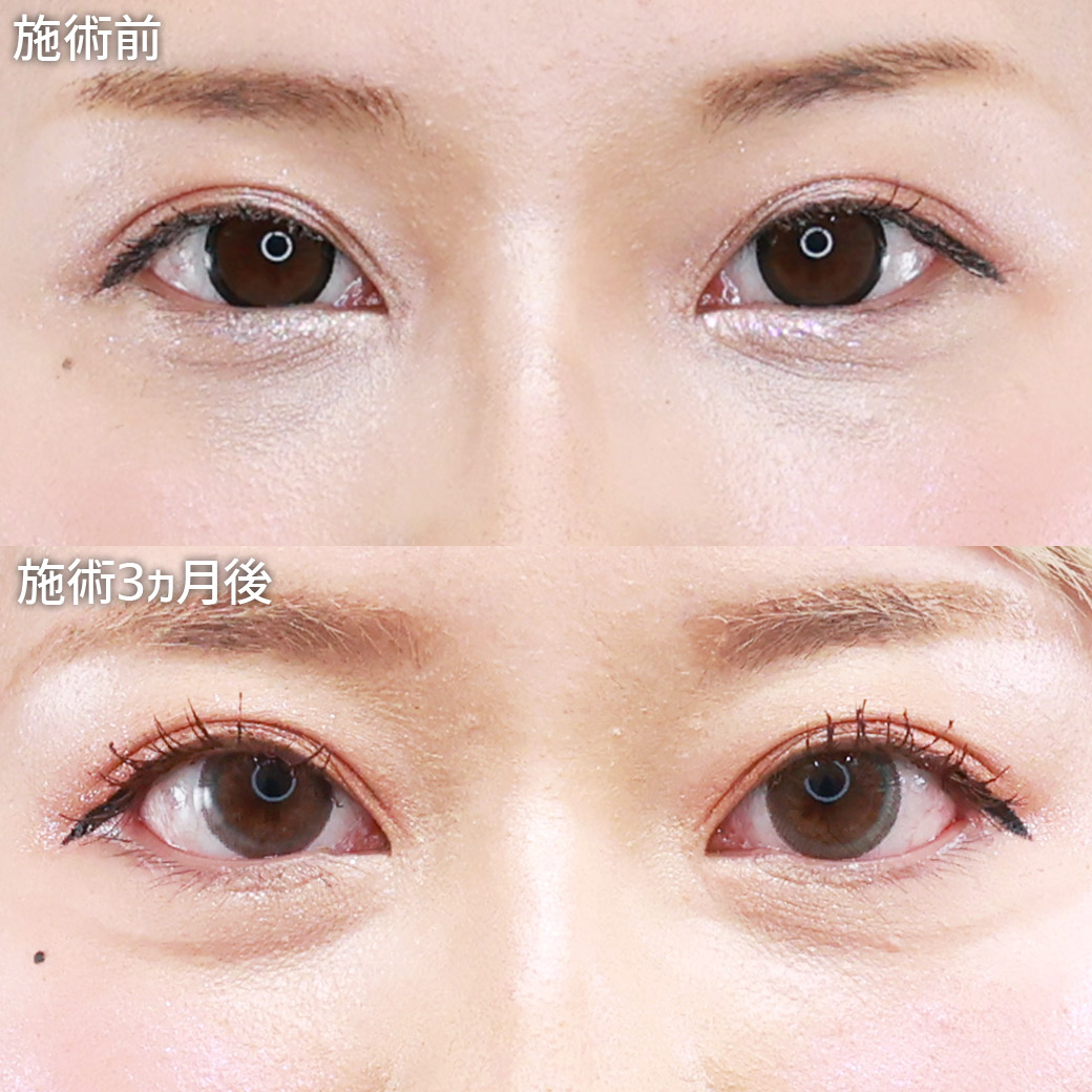 【グラマラスライン形成】目と黒目の露出範囲を広げて、憧れのデカ目に