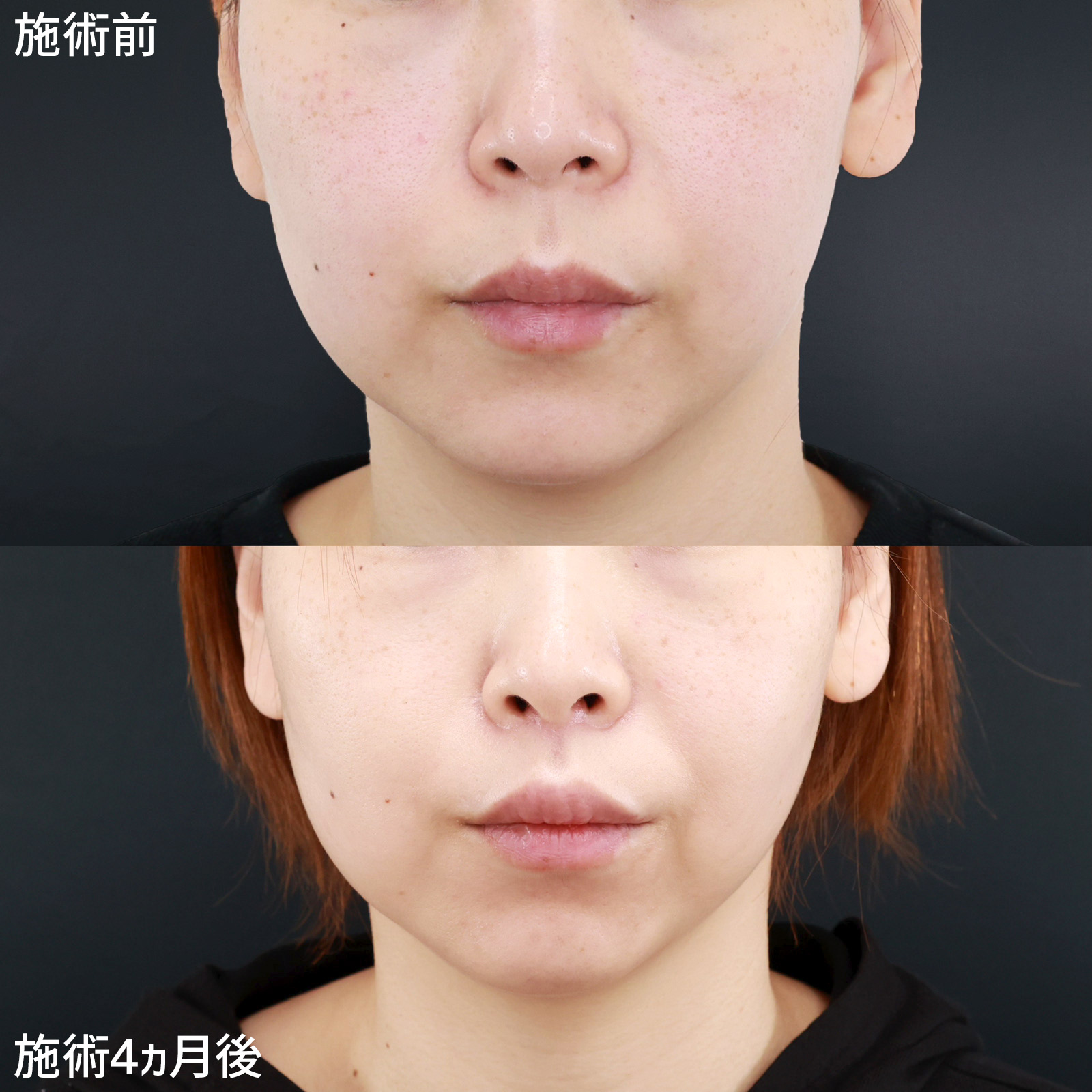 人中短縮術(リップリフト)・外側人中短縮術の症例写真 施術前後