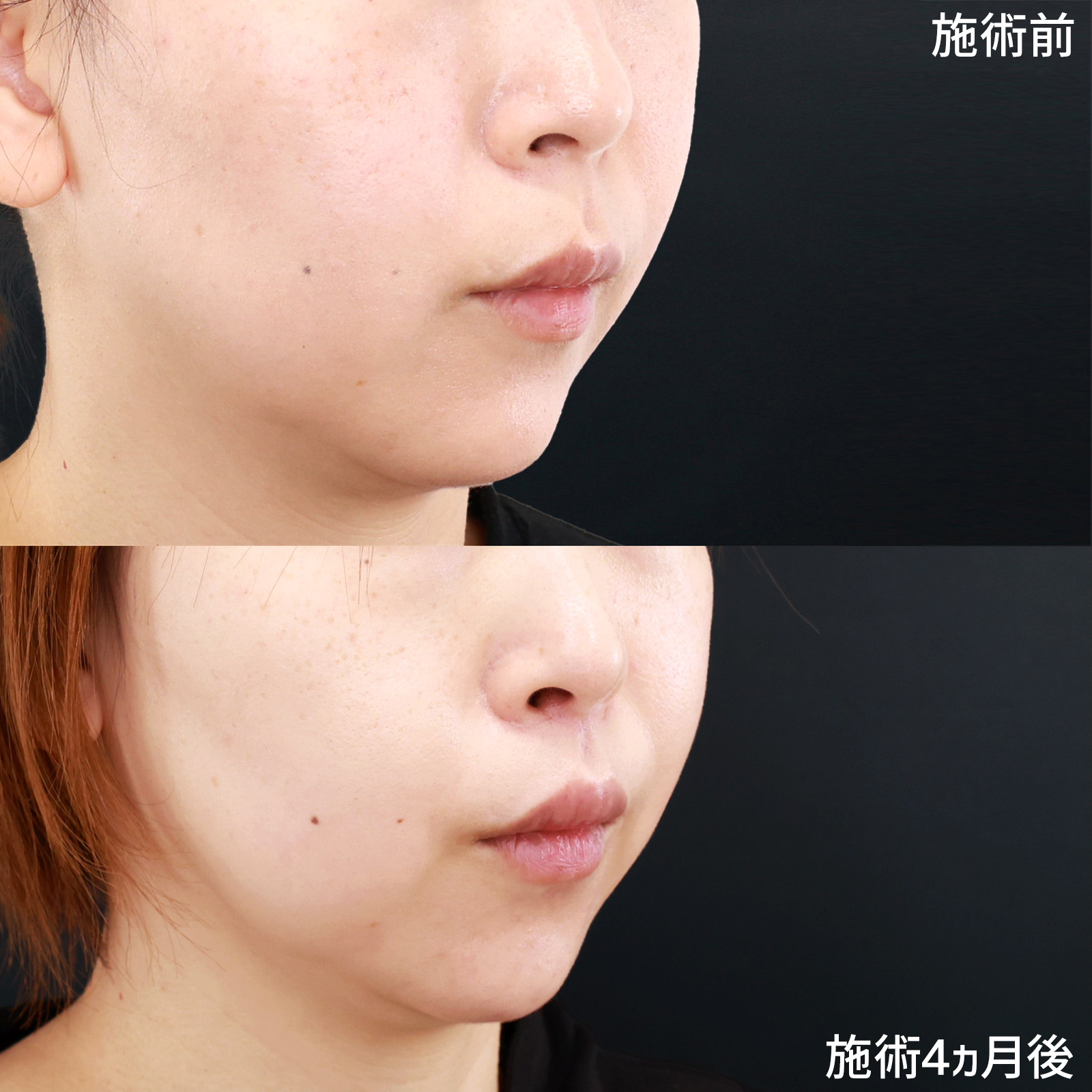 人中短縮術(リップリフト)・外側人中短縮術の症例写真 施術前後