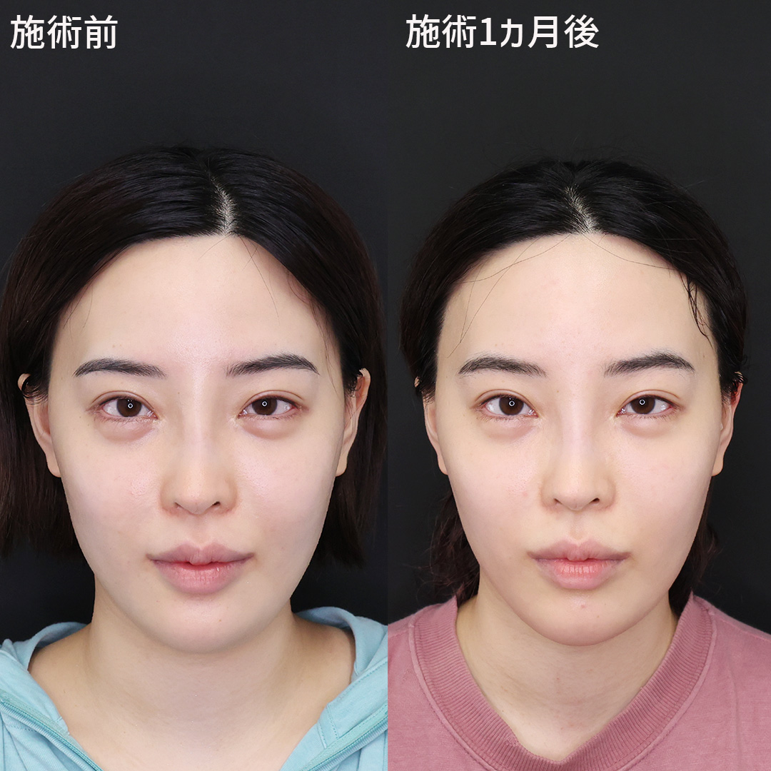 フェイスリフト（切開）/顔の脂肪吸引の症例写真 施術前後 