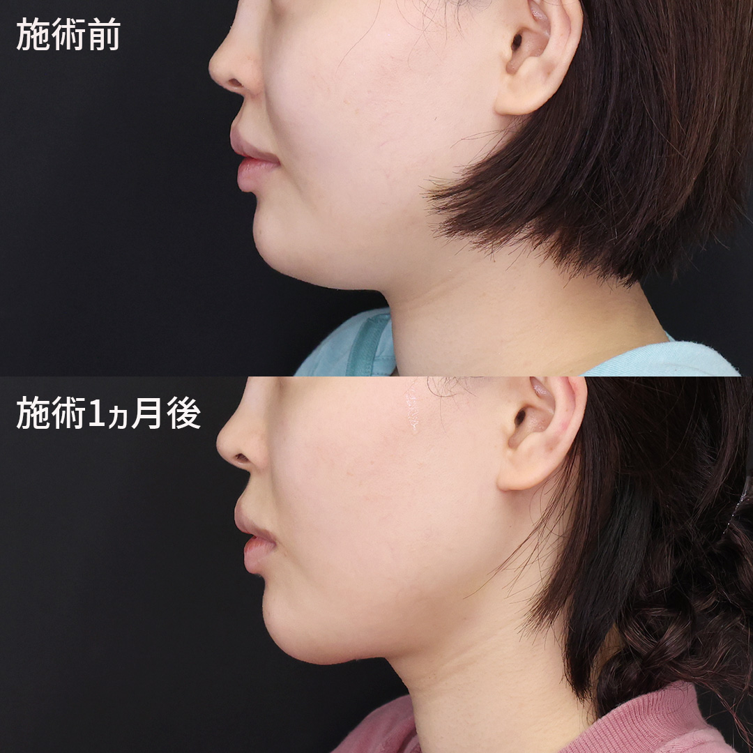 フェイスリフト（切開）/顔の脂肪吸引の症例写真 施術前後 