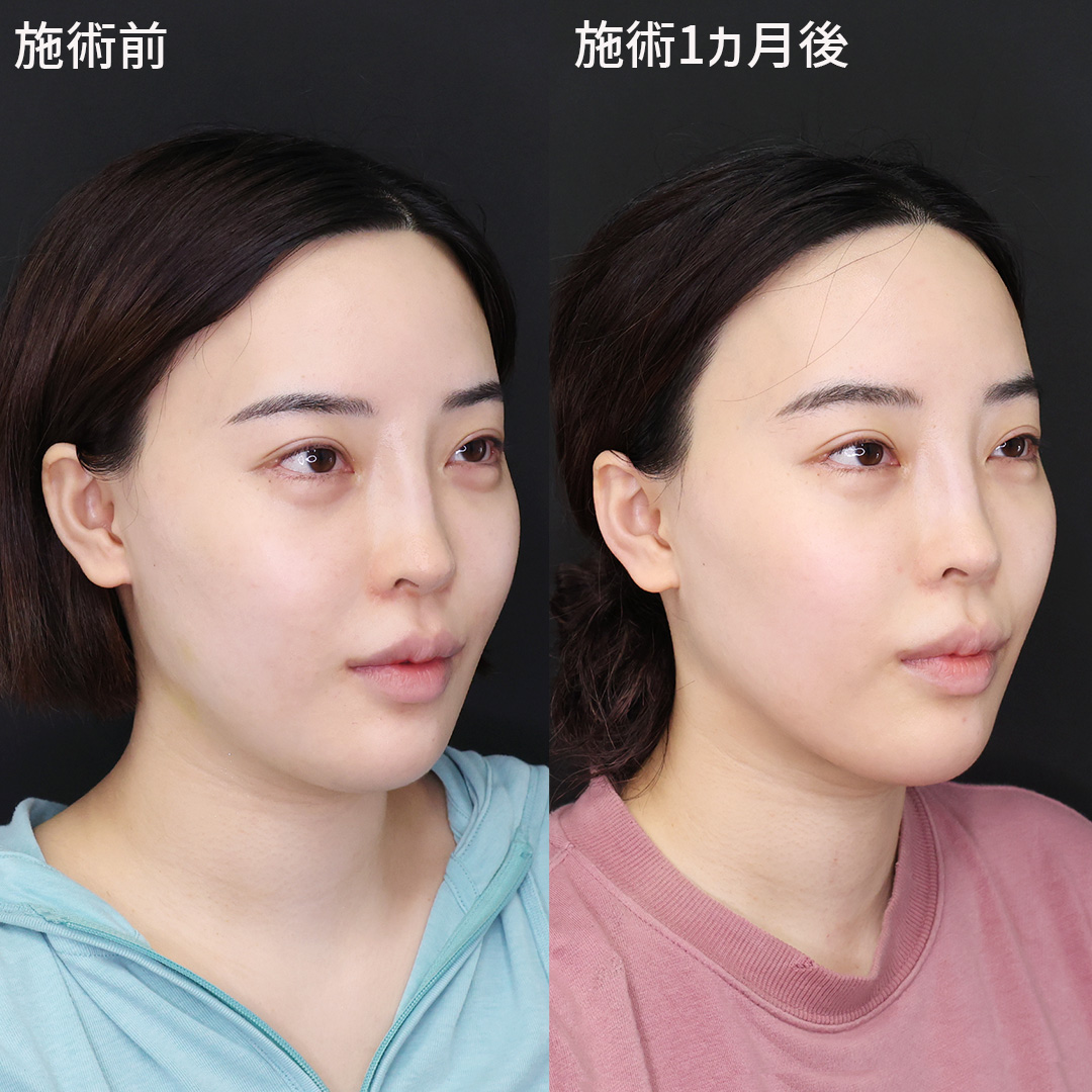 フェイスリフト（切開）/顔の脂肪吸引の症例写真 施術前後 