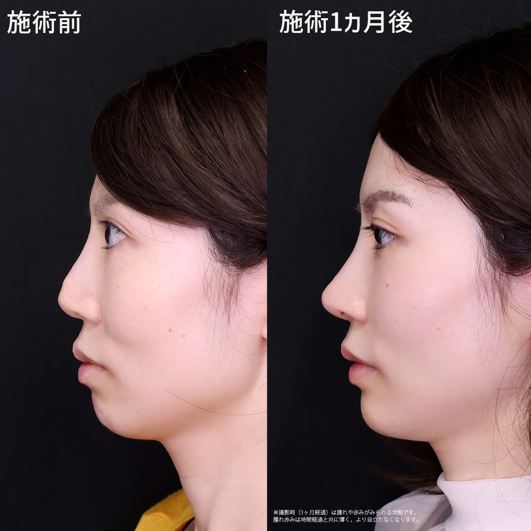 【鼻の他院修正】高くシャープな鼻に生まれ変わる