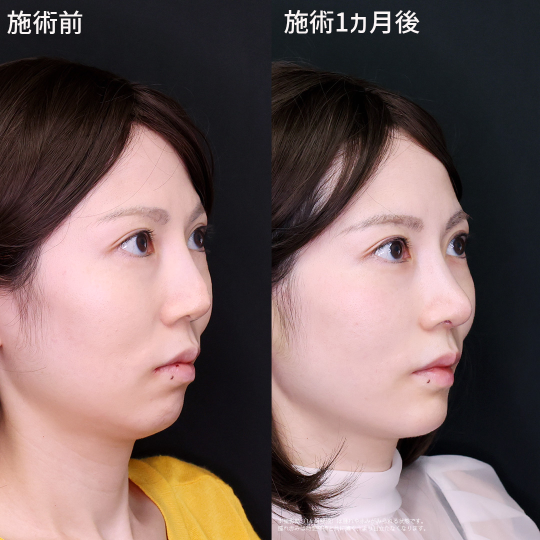 鼻中隔延長術/鼻尖形成・鼻尖縮小/鼻先軟骨移植の症例写真 施術前後 