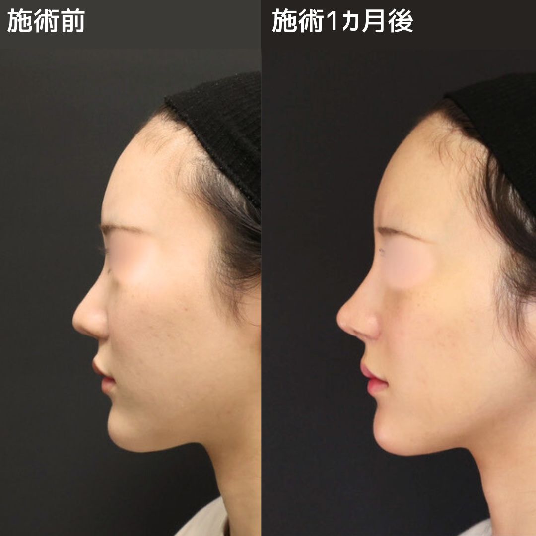 【鼻整形】他院修正から韓国アイドル風アップノーズへ