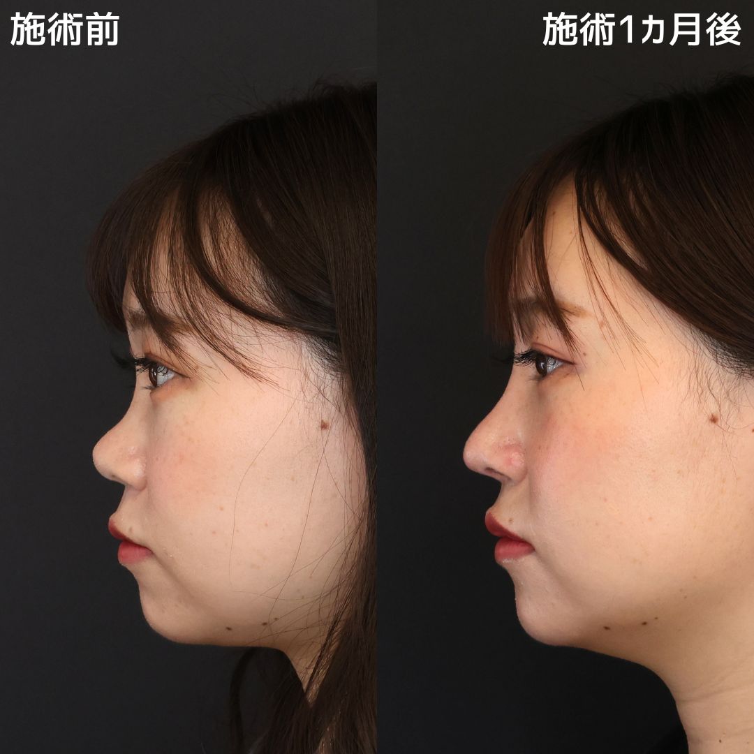 【忘れ鼻】形成外科専門医による鼻の他院修正