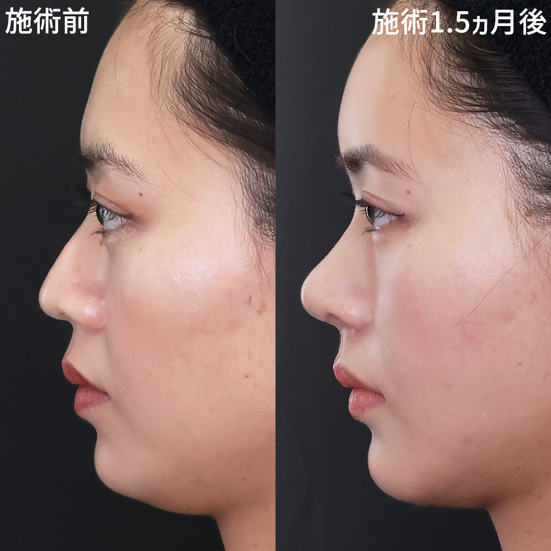 横顔美人はこう作る。Dr.古川の鼻整形