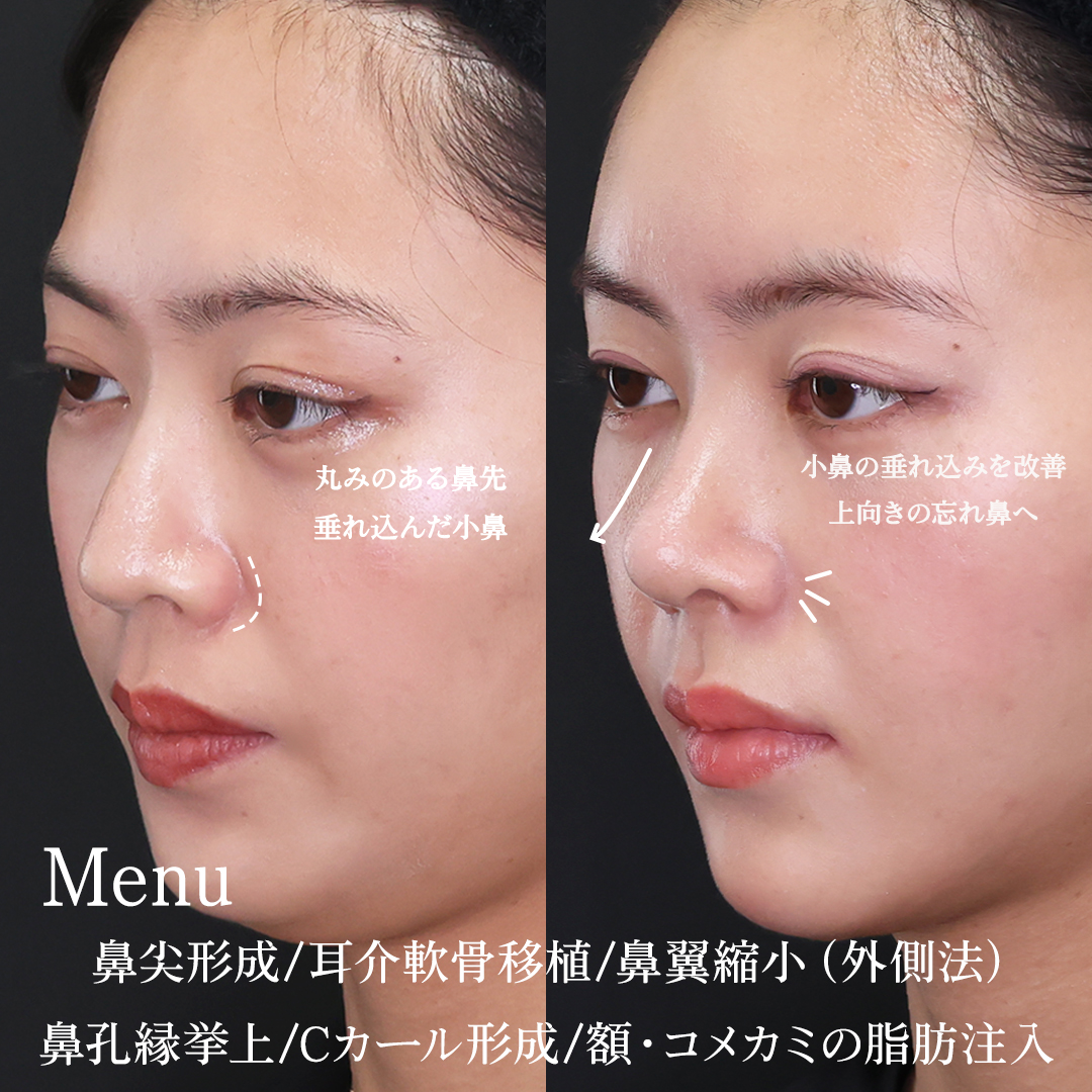 TAC式 ツヤ肌コラーゲンリフト®/顔の脂肪吸引/顔の脂肪注入(コンデンスリッチフェイス)の症例写真 施術前後 