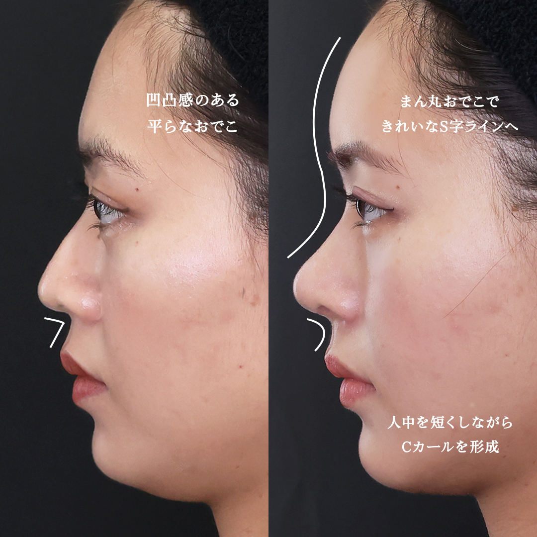 TAC式 ツヤ肌コラーゲンリフト®/顔の脂肪吸引/顔の脂肪注入(コンデンスリッチフェイス)の症例写真 施術前後 