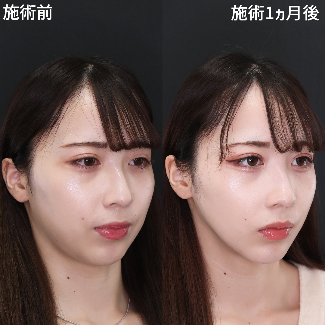 【糸リフト】でどこからみても美しい輪郭へ