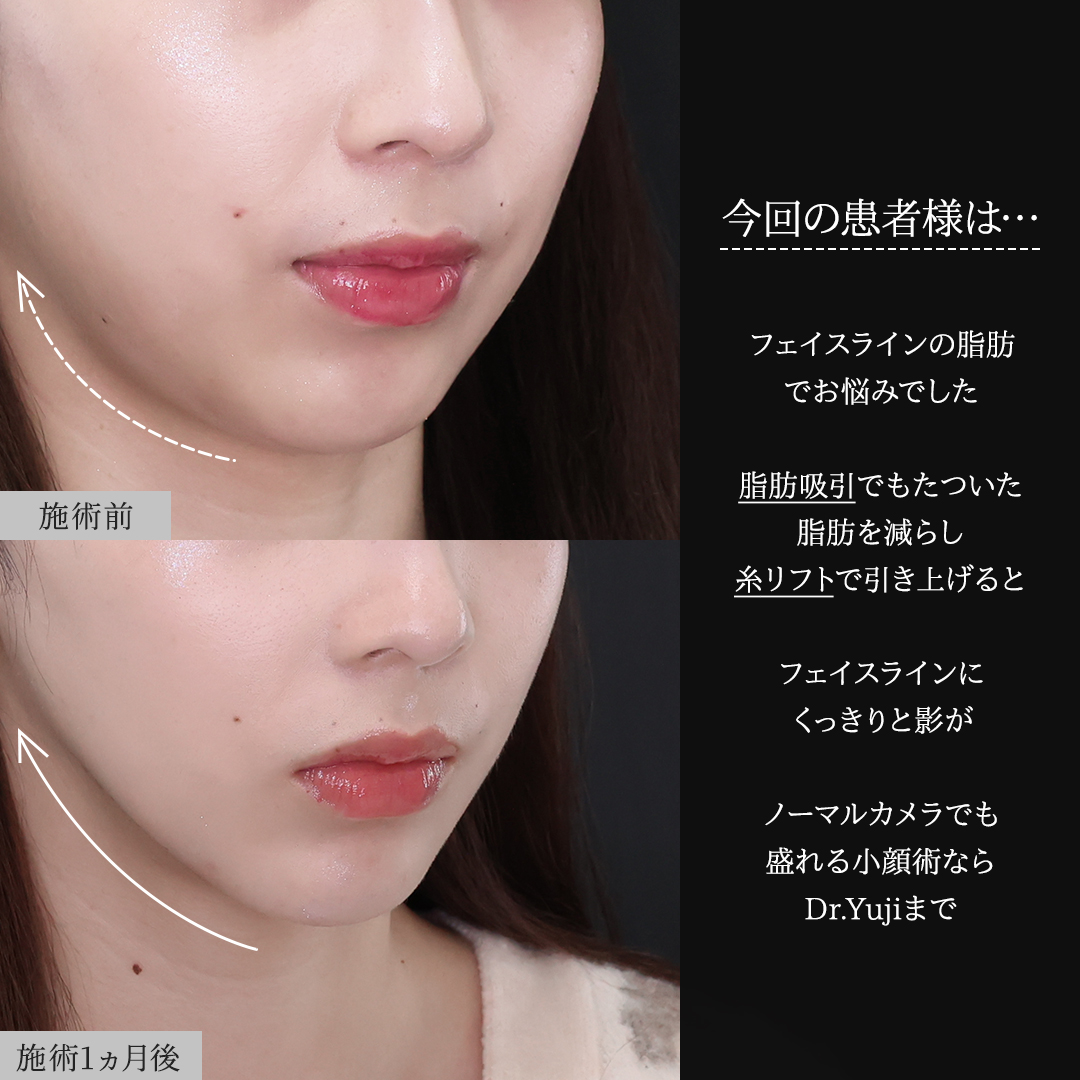 TAC式 ツヤ肌コラーゲンリフト®/顔の脂肪吸引/ジョールファット除去の症例写真 施術前後 