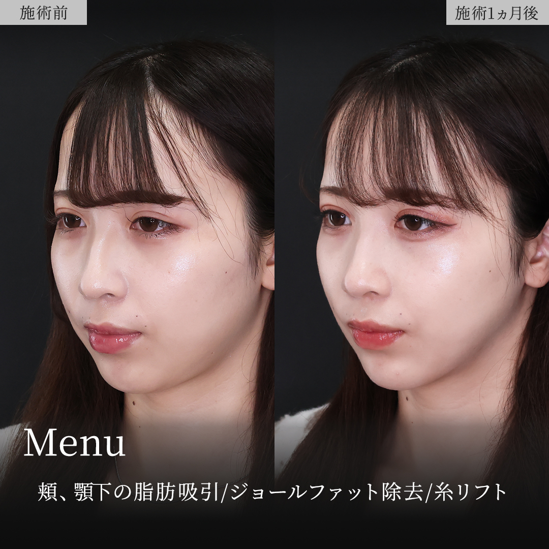 TAC式 ツヤ肌コラーゲンリフト®/顔の脂肪吸引/ジョールファット除去の症例写真 施術前後 