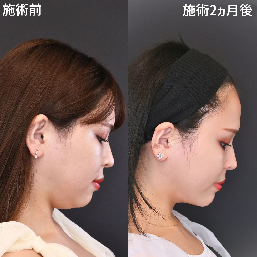 【二重アゴ改善】堂脇先生の小顔･脂肪吸引で、もっと可愛く◎