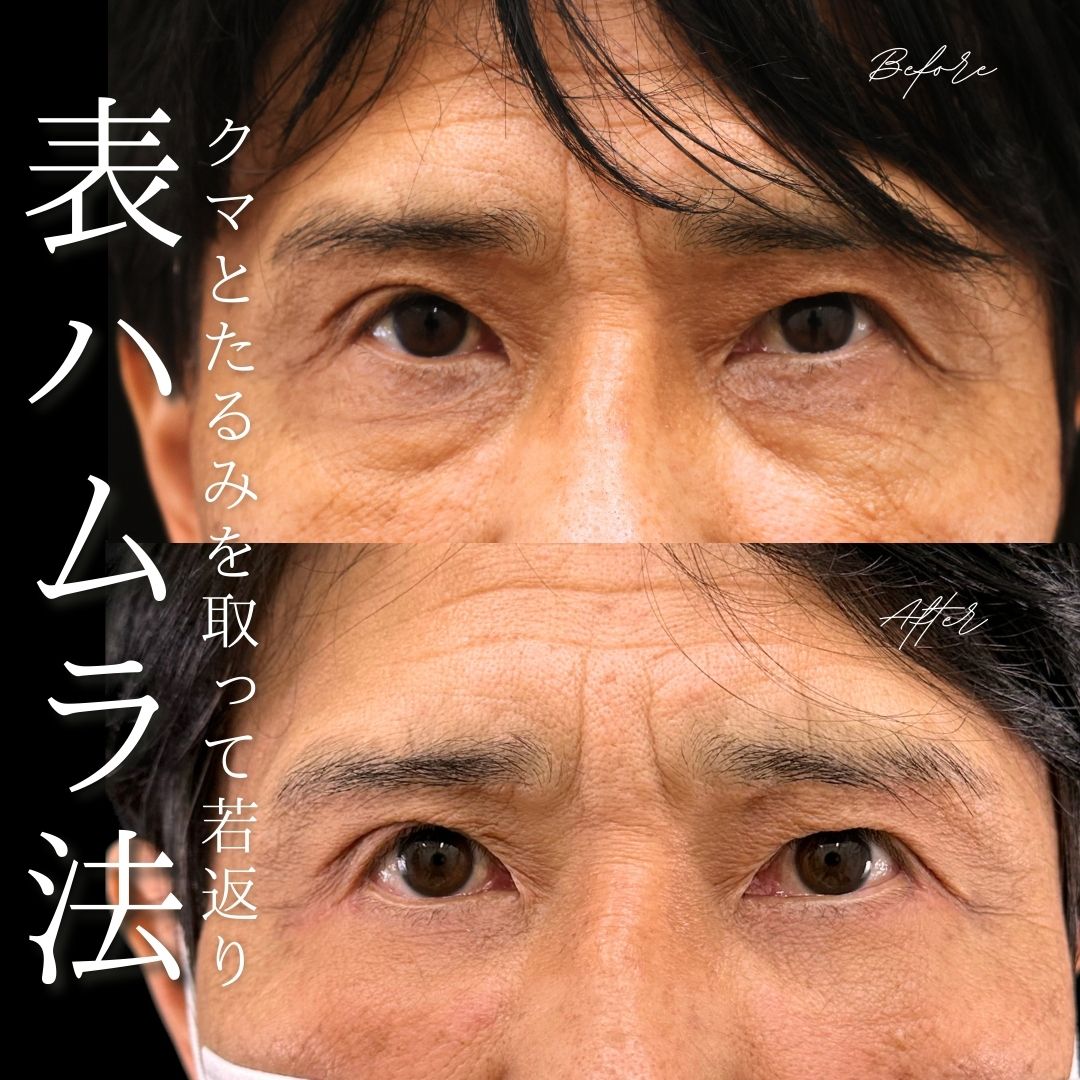 下眼瞼脱脂術（目の下のたるみ取り・目の下の脂肪ふくらみ取り）の症例写真 施術前後 