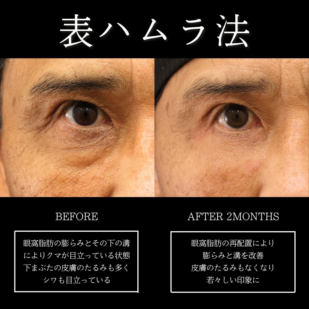 下眼瞼脱脂術（目の下のたるみ取り・目の下の脂肪ふくらみ取り）の症例写真 施術前後 