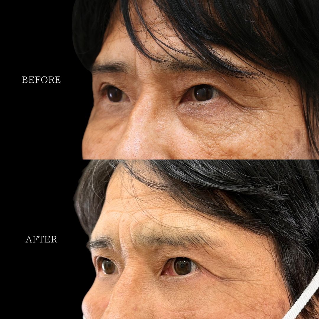 下眼瞼脱脂術（目の下のたるみ取り・目の下の脂肪ふくらみ取り）の症例写真 施術前後 