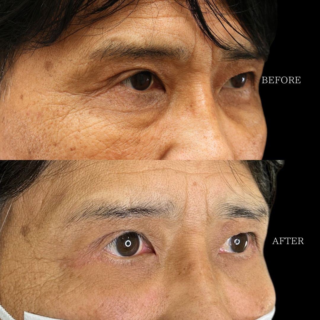 下眼瞼脱脂術（目の下のたるみ取り・目の下の脂肪ふくらみ取り）の症例写真 施術前後 