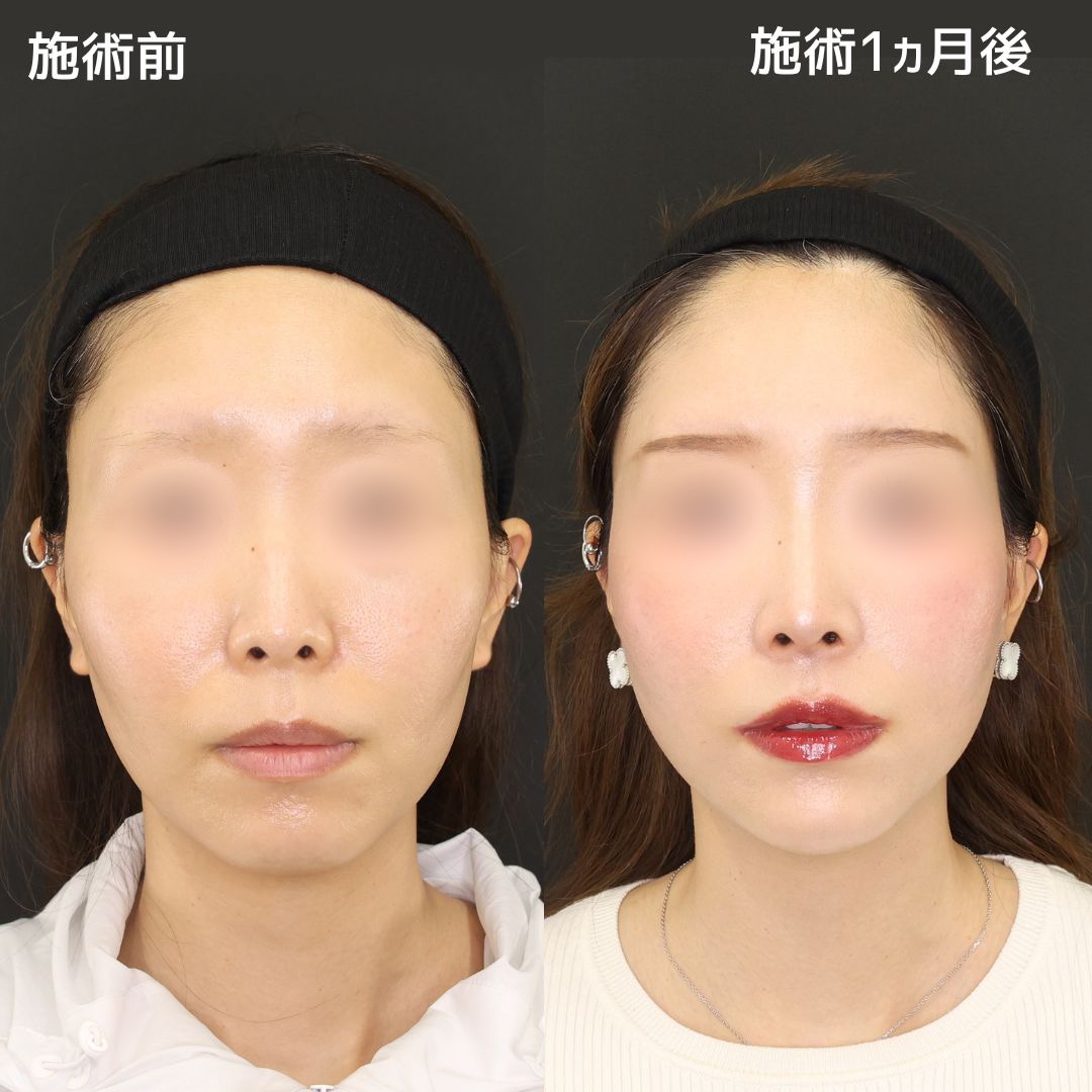 《糸リフトで小顔》プチ整形でこんなにコンプレックスが解消できるなんて