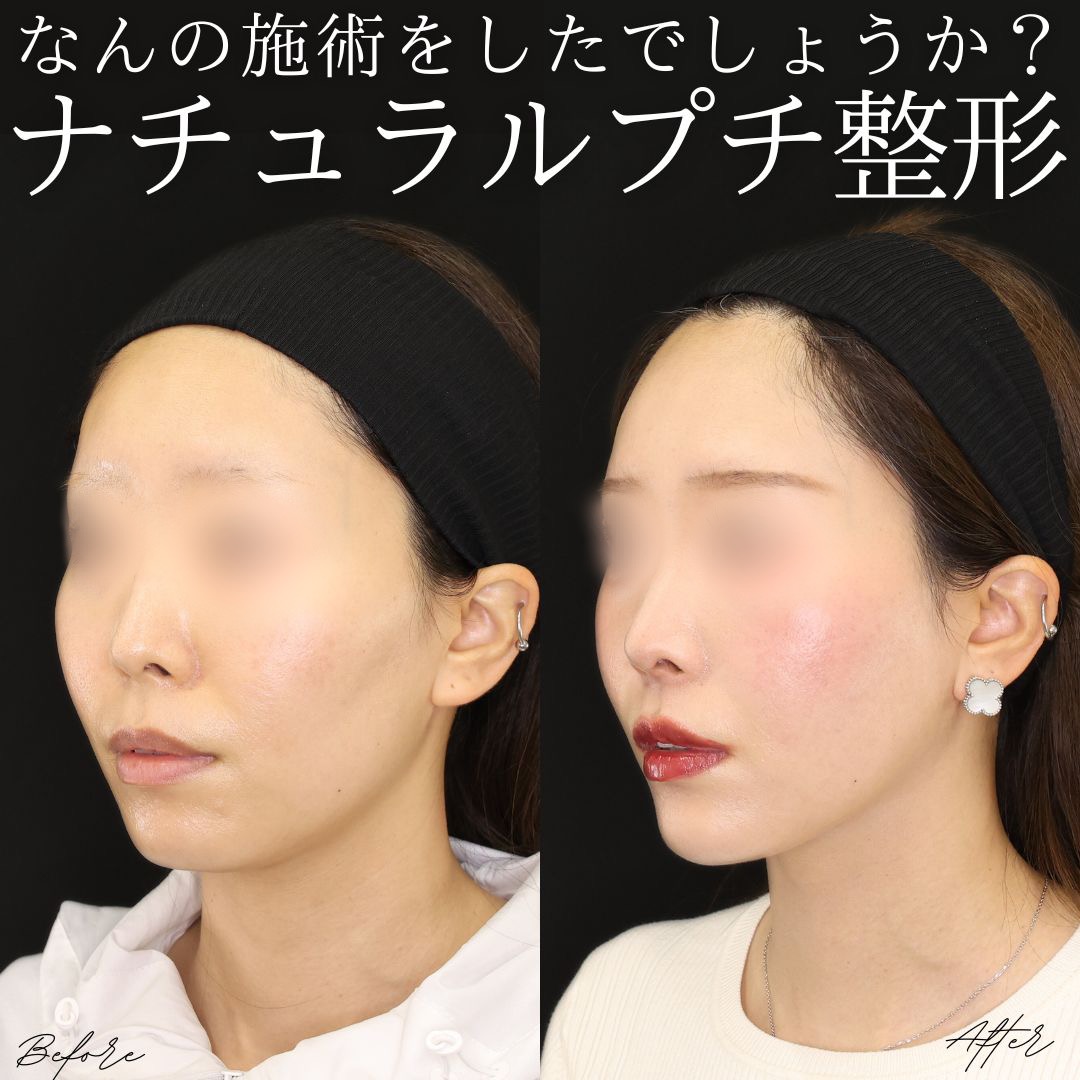 TAC式 ツヤ肌コラーゲンリフト®/エラボトックス注射/顎のヒアルロン酸注射の症例写真 施術前後 