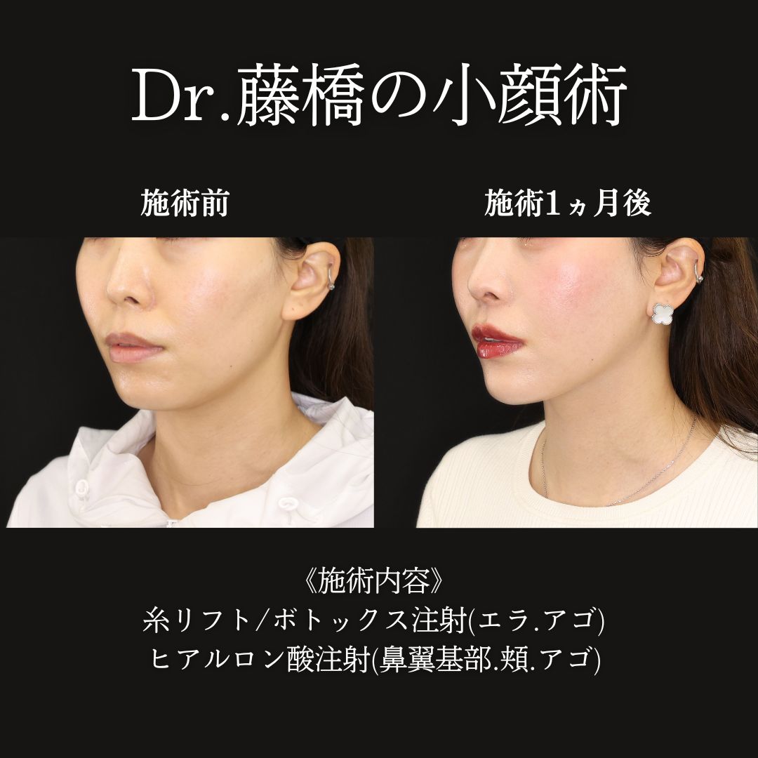 TAC式 ツヤ肌コラーゲンリフト®/エラボトックス注射/顎のヒアルロン酸注射の症例写真 施術前後 