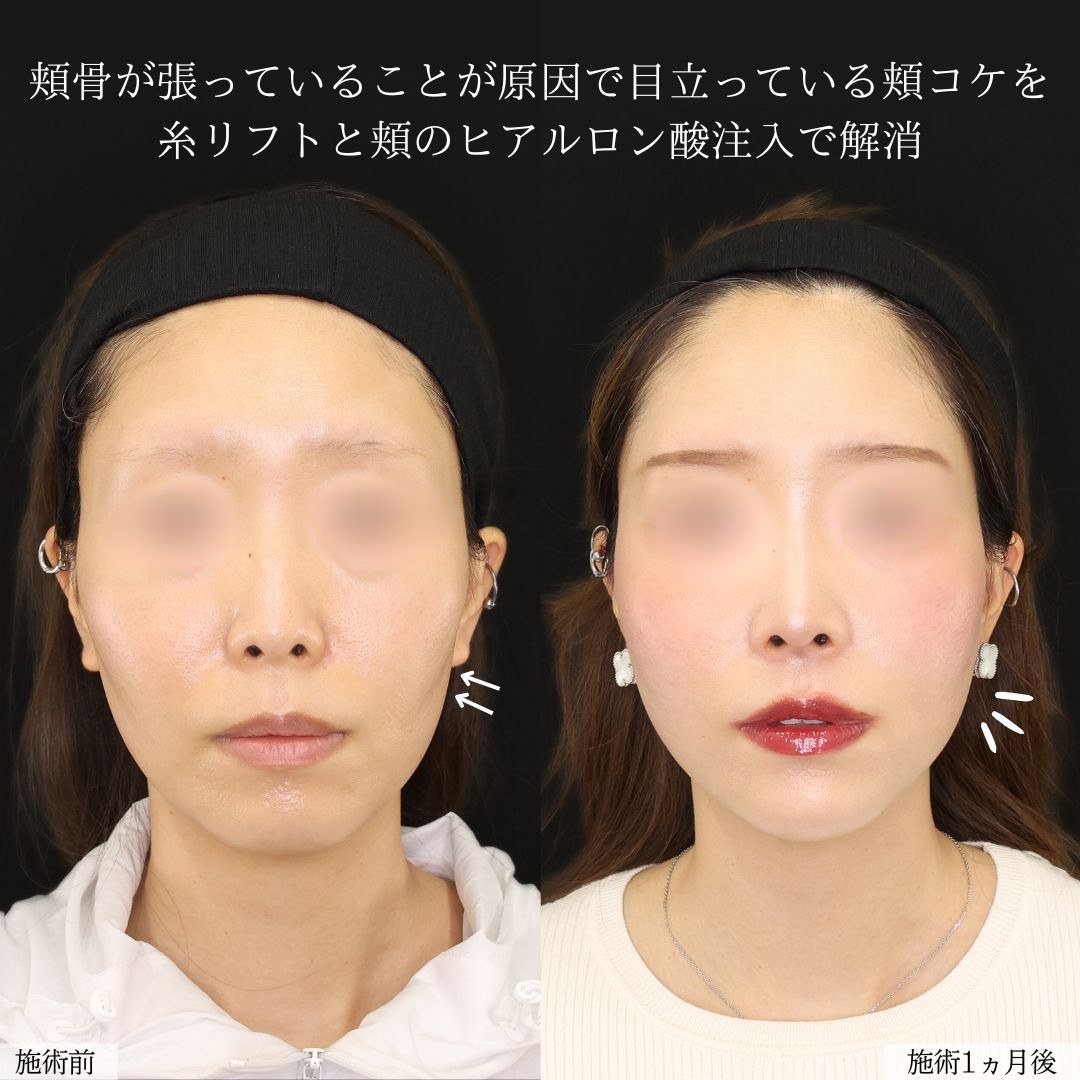 TAC式 ツヤ肌コラーゲンリフト®/エラボトックス注射/顎のヒアルロン酸注射の症例写真 施術前後 