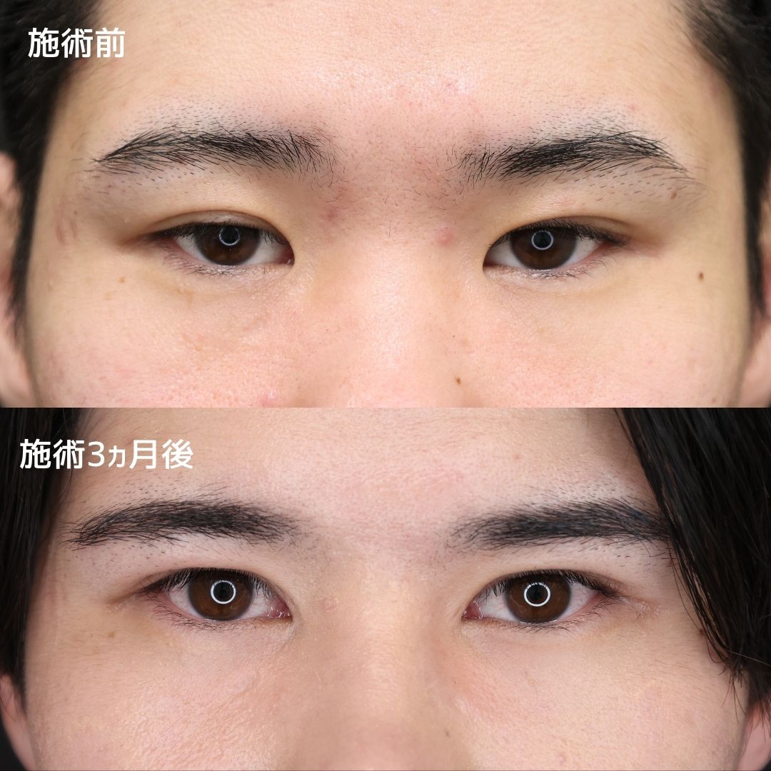 《20代メンズ》目頭切開と眼瞼下垂で瞳に光が入る目元を