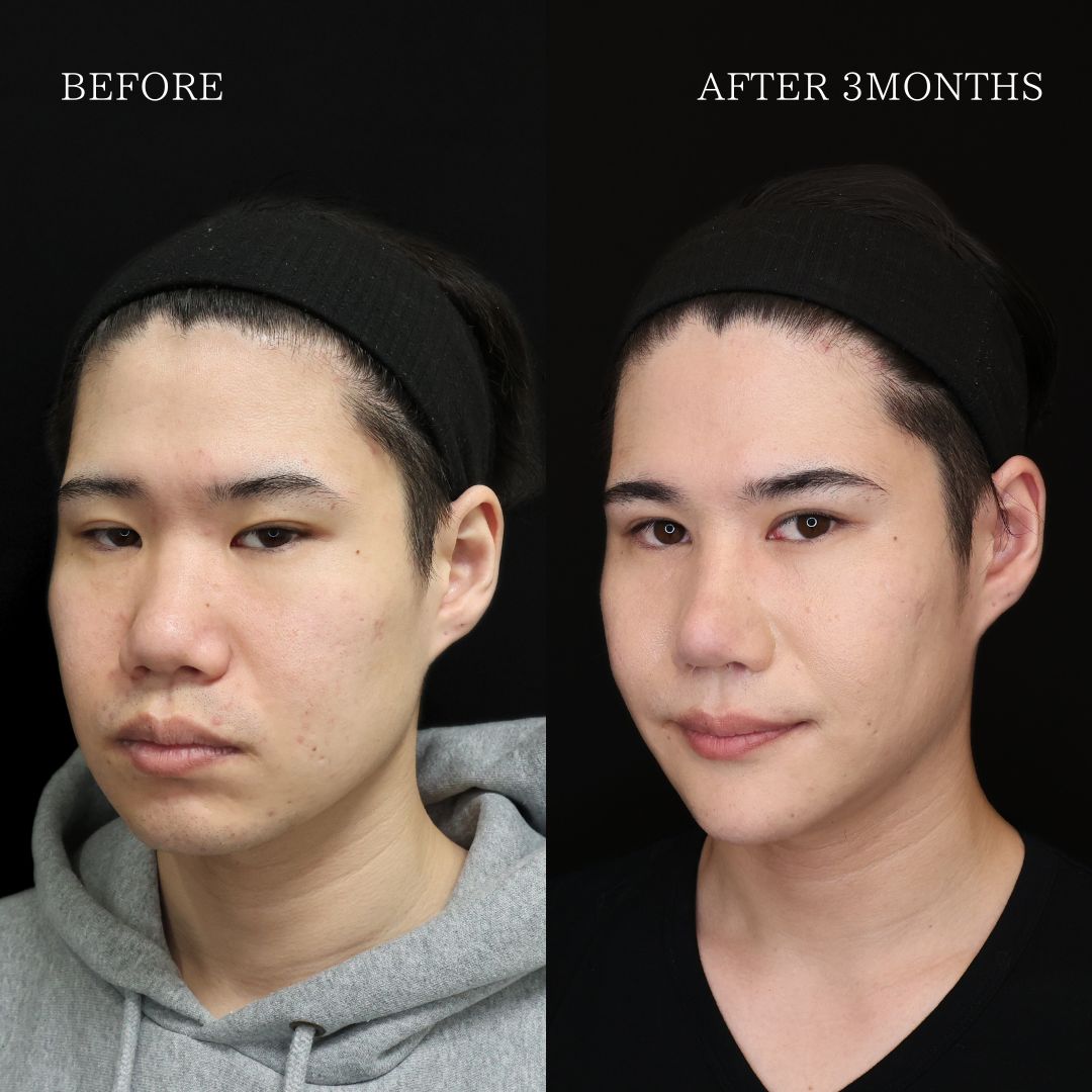 目頭切開術/眼瞼下垂（目つき矯正）の症例写真 施術前後 